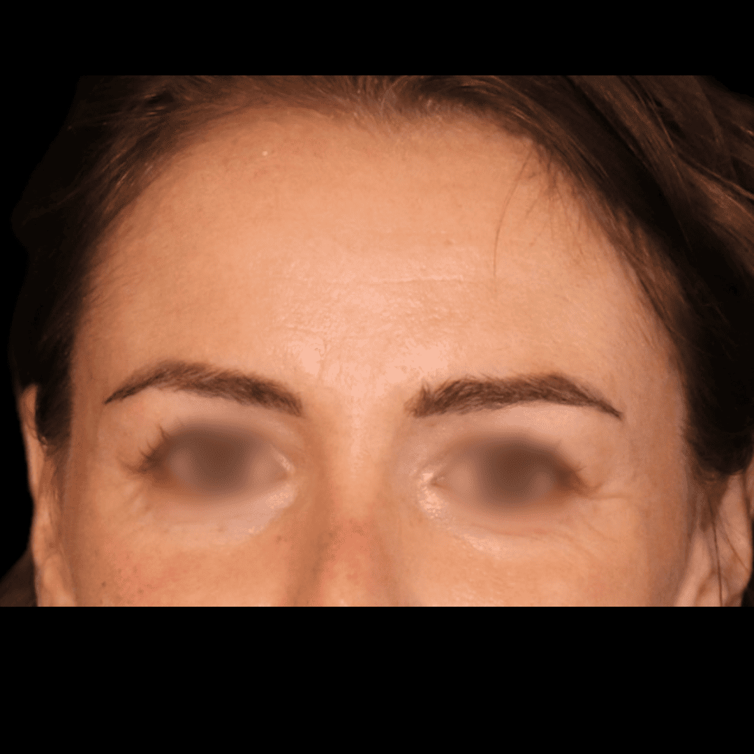 Botox - AVANT FACE