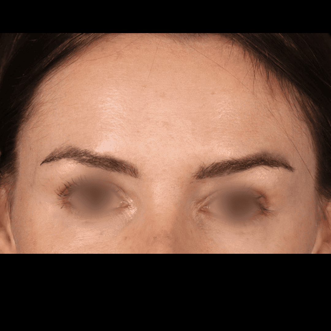 Botox - APRÈS FACE